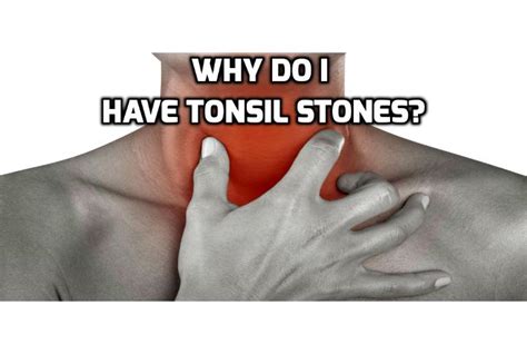 How To Have A Healthy Life How Do I Develop Tonsil Stones In The