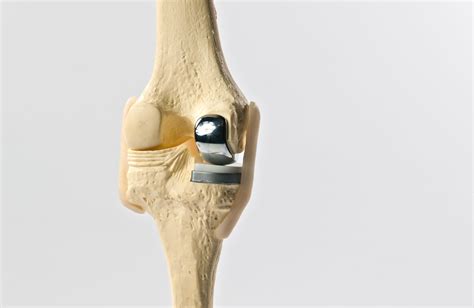 Une prothèse du genou est un implant articulaire interne qui remplace les surfaces articulaires défaillantes du genou, dans le but de permettre de nouveau un appui stable, la flexion et l'extension, et de récupérer un bon périmètre de marche. Prothèse de genou unicompartmentaire | Dr. Michael Serhal