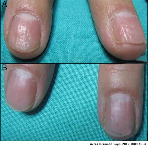 Treatment Of Nail Psoriasis With Pulse Dye Laser Plus Calcipotriol
