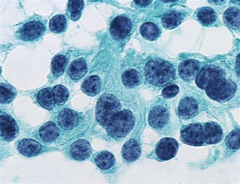 Pathology Outlines Hürthle Cell Neoplasm