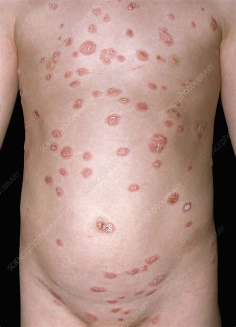 Guttate Psoriasis Stock Image C0494465 Science Photo Library
