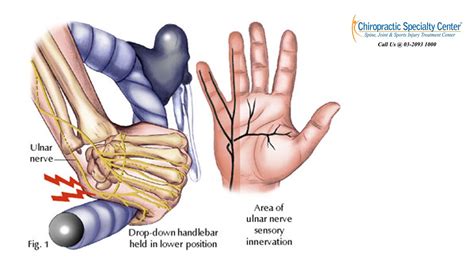 Ulnar Nerve Compression And Injury At The Wrist