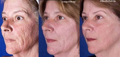 Laser Resurfacing Before And After Beauty Before And After Photos