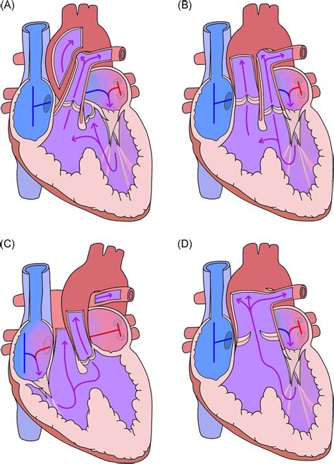Tricuspid Atresia Where Are We Now Sumal 2020 Journal Of