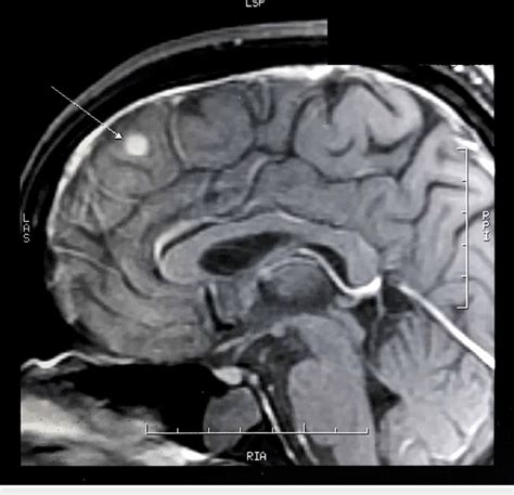 Neurocysticercosis In The Right Frontal Lobe Of The Brain On Mri