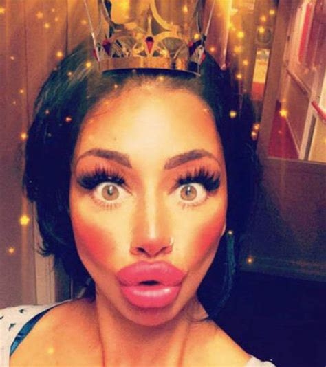 Irreversible Plastic Surgery Fails That Are Straight Up Scary 39 Pics