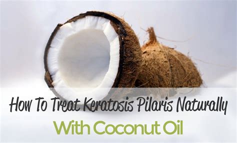 Keratosis Pilaris Coconut Oil Keratosis Pilaris Coconut Oil