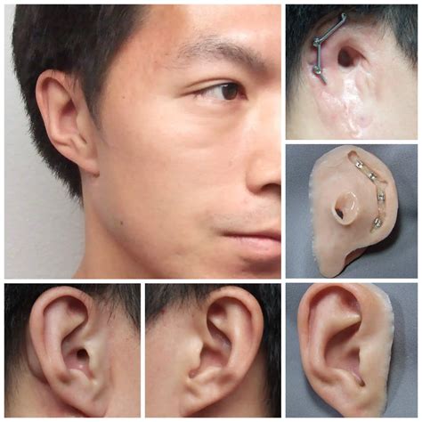 ear prosthesis photo gallery medical art prosthetics