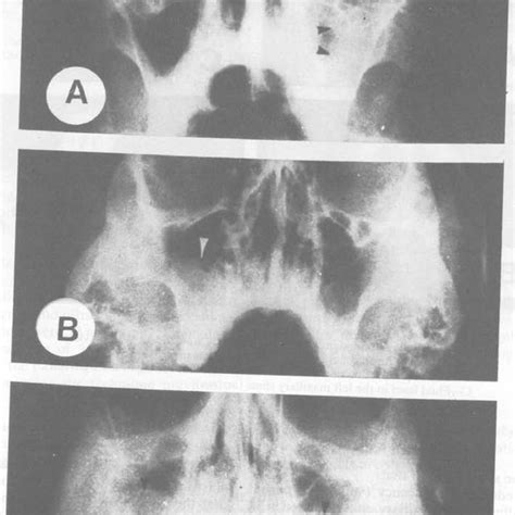 Radiographic Signs Of Chronic Maxillary Sinusitis On Waters View