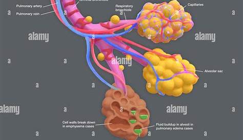 Annotated illustration of diseased human alveoli. The alveoli are air