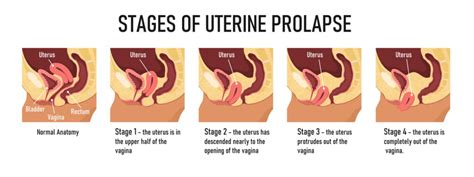 The Different Stages Of Pelvic Organ Prolapse Nancy Branberg PT