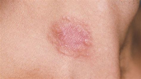 Skin Cancer Rash Idaman