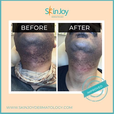 Laser Hair Removal In Austin Tx Skin Joy Dermatology