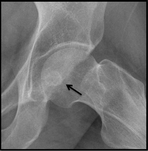 T1 Weighted Axial Mri Showing A Corresponding Hypointense Lesion White