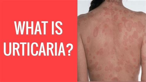 The Hives Fluurticaria You Dont Know About Readersfusion