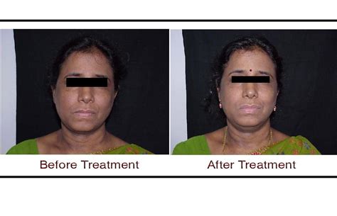 Thermage Before And After Face Clinic2000