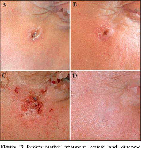 Figure 3 From Cryosurgery Is More Effective In The Treatment Of Primary