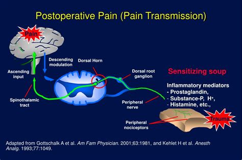 Ppt Acute Pain Postoperative Management Powerpoint Presentation