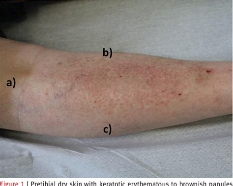 Figure 1 From A Case Report And Differential Diagnosis Of Pruritic