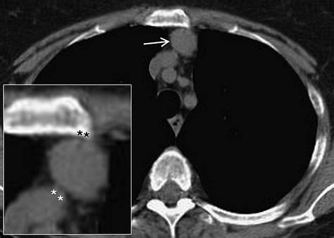 Imaging Of Thymus In Myasthenia Gravis From Thymic Hyperplasia To