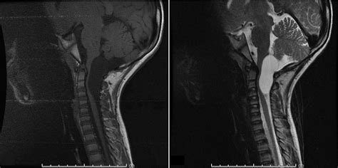 Neurenteric Cyst At The Dorsal Craniocervical Junction In A Child Case