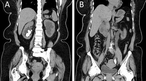 Recurrent Nephrolithiasis Causing Kidney Failure American Journal Of