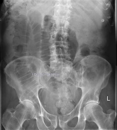 Sboadhesions Radiology At St Vincents University Hospital