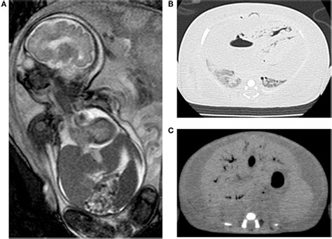 Frontiers Pulmonary Hypoplasia Caused By Fetal Ascites In Congenital Cytomegalovirus Infection