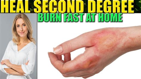 How To Heal A Burn Quickly Heal Info