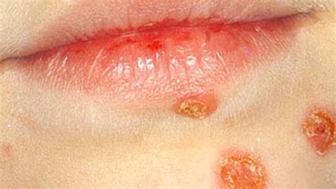 Impetigo Is A Contagious Skin Infection — Heres How To Ensure Your