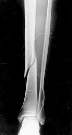 Picture Of Spiral Fracture Of Fibula Spiral Fracture Healing Time