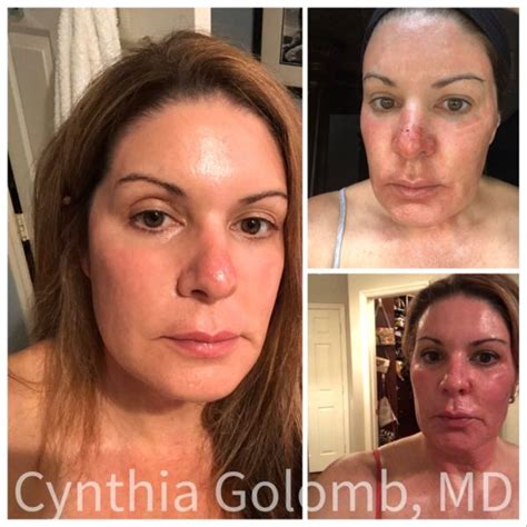 Fabulous Results After One Co Coolpeel Laser Treatment Read The Review