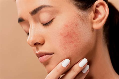 Struggling With Hormonal Acne Why It Happens And How To Treat It Dr Jill Carnahan Md