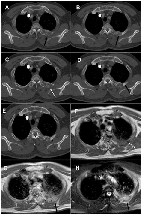 The Imaging Manifestations Of Rib Metastases In Lung Cancer Comparing