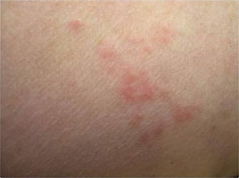 Guide To Bed Bug Bite Signs Symptoms And Treatment Free Brochures