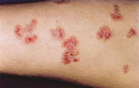 Herpetiform During Dermatitis Pictures Symptoms And Pictures