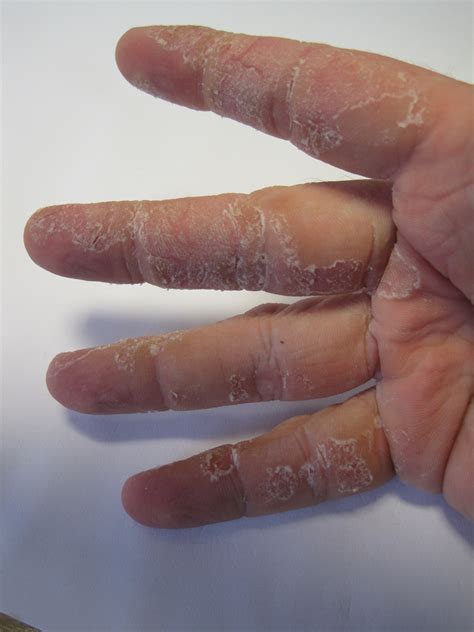 I Have Really Dry Skin On My Hands And Fingers My Fingers