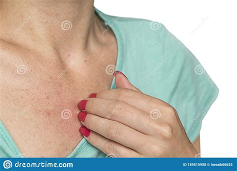 Pimples On The Chest Of A Young Woman Stock Photo Image Of Isolated