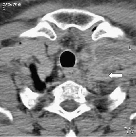 Contrast Enhanced Computed Tomography Ct Of The Neck And Chest Of The