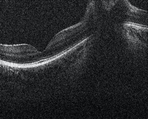 Moran Core Optic Nerve And Macular Oct In Hurler Syndrome Mps I