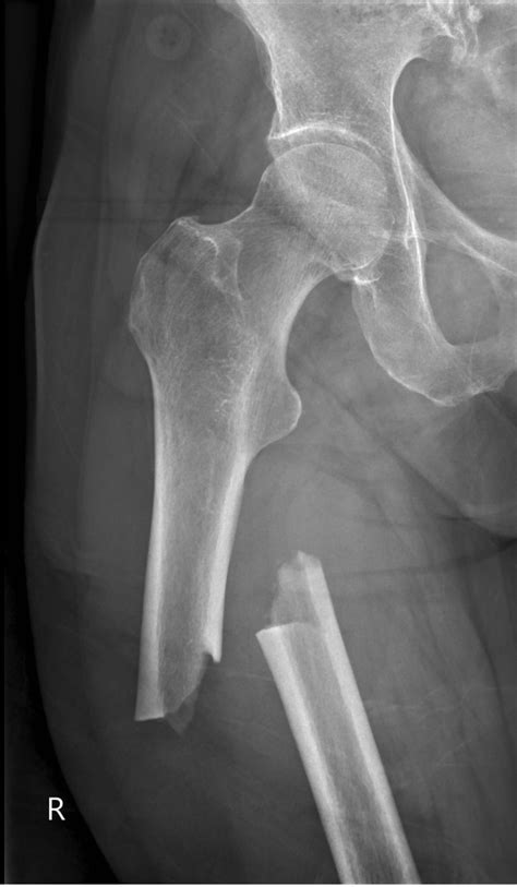 Femur Fractures Radiology