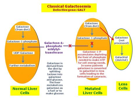 Galactosemia Hereditary Ocular Diseases