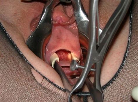 Pee Hole Opened Up With Speculum Best Gore