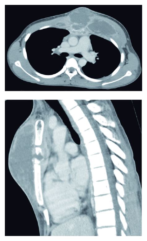 A Chest Ct Scan Upper And Reconstructed Sagittal Image Lower