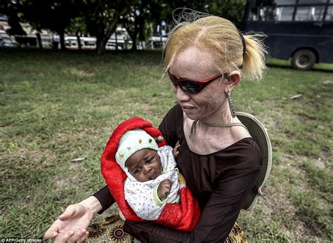 Tanzania Albino Girl Among Hundreds Seeking Refuge From Murderous Witch Doctors Daily Mail Online