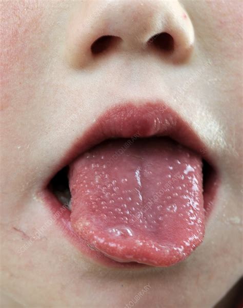 Tongue In Scarlet Fever Stock Image C0238952 Science Photo Library