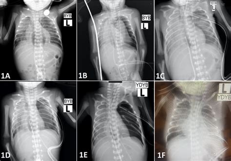 A Initial X Ray Showing Pneumomediastinum B Left Pneumothorax And