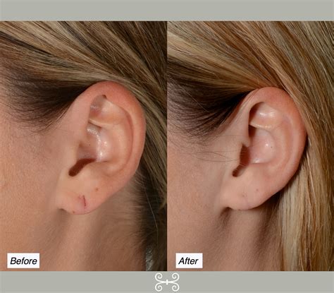 Stretched Piercing Charleston Facial Plastic Surgery