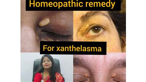Homeopathic Treatment For Xanthelasmapermanent Treatment Cost