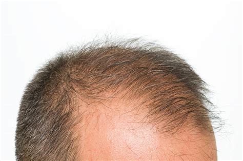 1500 Bald Spot Stock Photos Pictures And Royalty Free Images Istock